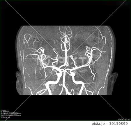 MRI of the blood vessels i MRI of the blood vessels i 59150399