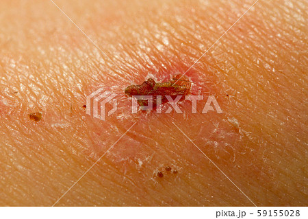 Close up of a scar 59155028