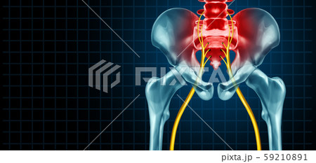 Painful Sciatic Nerve Painful Sciatic Nerve 59210891