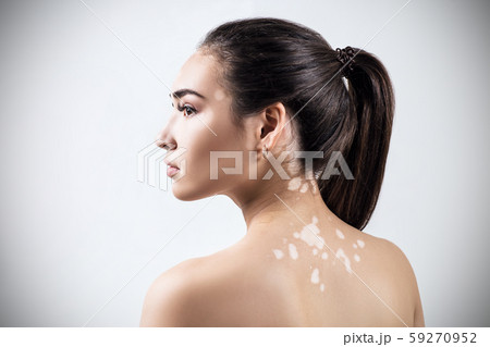 Portrait of beautiful woman with vitiligo. 59270952