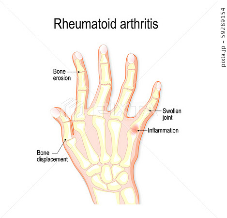 hand with rheumatoid arthritis and typical joint swelling and deformation of the fingers and knuckles. bone anatomy. vector illustration for medical use 59289154