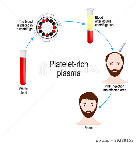 Platelet-rich plasma. PRP Hair Therapy. Medical procedure. Process by which a hair restoration surgeon takes a patient's blood, removes the erytrocytes and plasma, then injects PRP 59289155