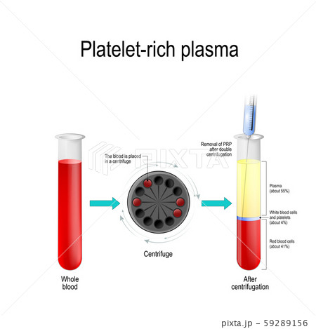 Platelet-rich plasma. Autologous conditioned plasma, is a concentrate of platelet-rich plasma derived from whole blood, centrifuged to remove red blood cells. blood test tube, centrifuge, syringe 59289156