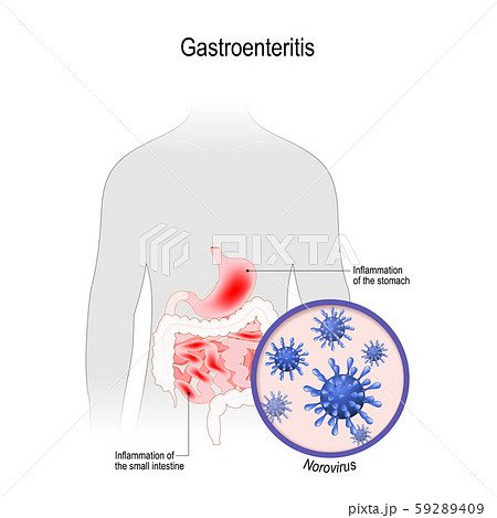 gastroenteritis. Viral disease that caused by noroviruses. human silhouette with Inflammation of the small intestine and stomach. 59289409