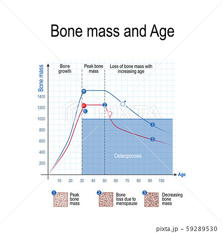 Bone mass for male and female. Age and osteoporosis. Chart. healthy lifestyle. Vector illustration for educational, science and medical use Bone mass for male and female. Age and osteoporosis. Chart. healthy lifestyle. Vector illustration for educational, science and medical use 59289530