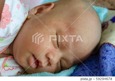 Newborn baby Asian  has rash 59294678