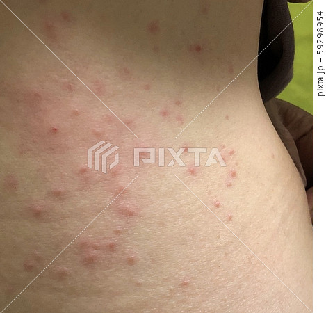 薬疹の写真素材 [59298954] - PIXTA
