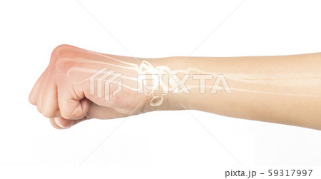 wrist bones injury white background wrist pain 59317997