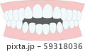 不正咬合　開咬　歯並び 59318036