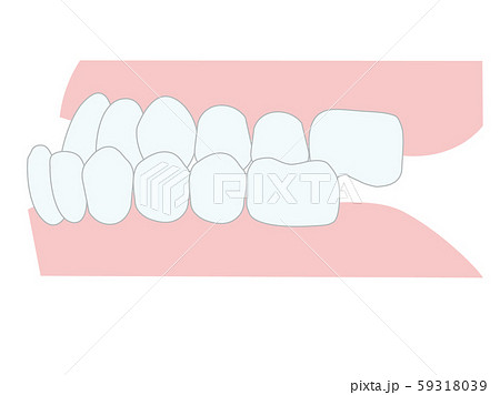 不正咬合 下顎前突 歯並び 不正咬合 下顎前突 歯並び 59318039