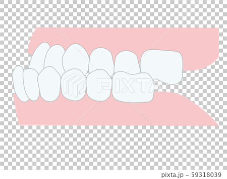 不正咬合 下顎前突 歯並び 不正咬合 下顎前突 歯並び 59318039