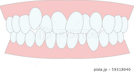 不正咬合　叢生　歯並び 59318040