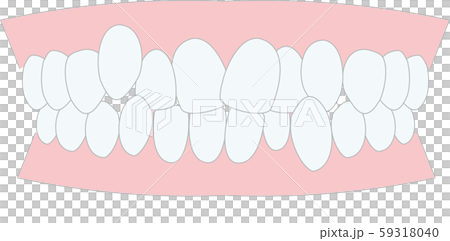 不正咬合　叢生　歯並び 59318040