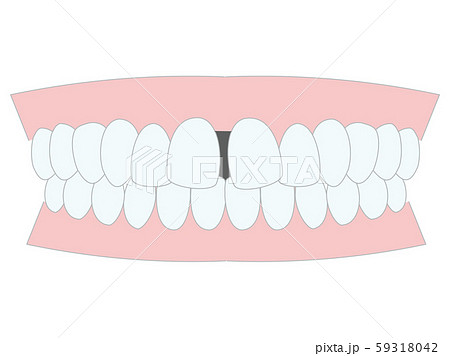 不正咬合　正中離開　歯並び 59318042
