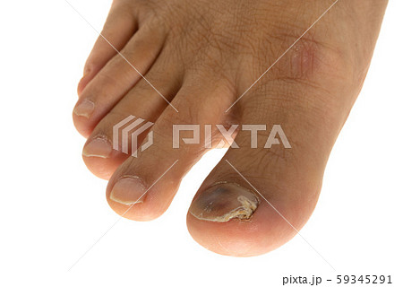 男性の足指先の爪水虫 男性の足指先の爪水虫 59345291