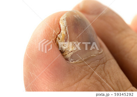 男性の足の親指の爪水虫 男性の足の親指の爪水虫 59345292