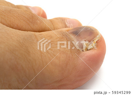 爪水虫 59345299
