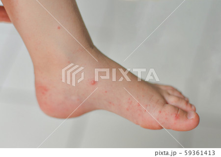 Enterovirus Leg arm mouth Rash on the body of a child Cocksackie virus 59361413