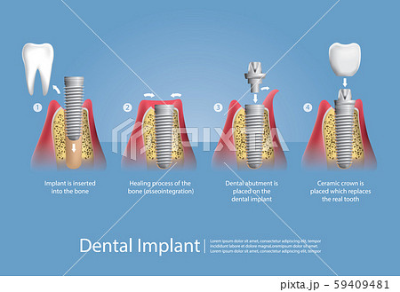 Human teeth and Dental implant Vector Illustration 59409481