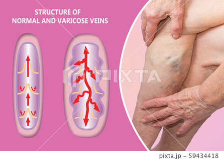 Varicose Veins On A Female Senior Legs. The Structure Of Normal