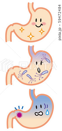 胃 ピロリ菌 がん イラストのイラスト素材