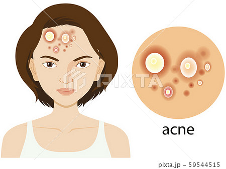Diagram showing woman with acne problem 59544515