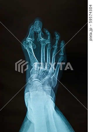 X-ray of the right foot. 59574304