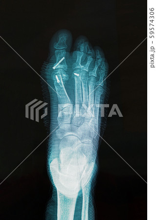 X-ray of foot after surgery to correct 59574306