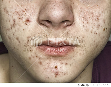 teenage acne on the face close up 59580727