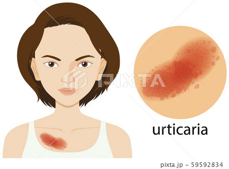 Diagram showing urticaria on human female Diagram showing urticaria on human female 59592834