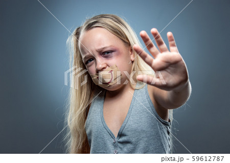 Sad and frightened little girl with bloodshot and bruised eyes, fiction of happiness Sad and frightened little girl with bloodshot and bruised eyes, fiction of happiness 59612787