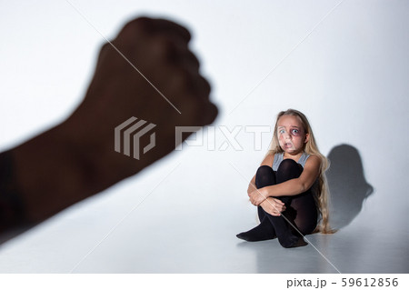 Sad and frightened little girl with bloodshot and bruised eyes sitting scared Sad and frightened little girl with bloodshot and bruised eyes sitting scared 59612856