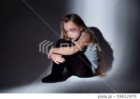 Sad and frightened little girl with bloodshot and bruised eyes sitting scared Sad and frightened little girl with bloodshot and bruised eyes sitting scared 59612970
