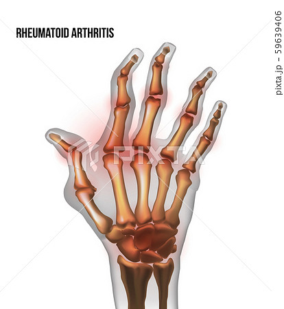 Rheumatoid arthritis image sore inflammation joints of bones the of hand. 59639406