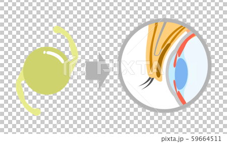 Intraocular lens and eye cross-section 59664511