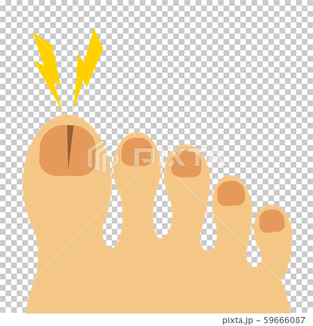 腳趾甲破裂 腳趾甲破裂 59666087