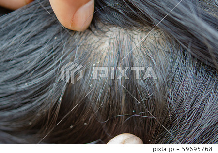 Louse egg Louse egg 59695768