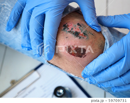 The doctor examines the healing wound of the patient on the leg of the knee torn jeans scarring The doctor examines the healing wound of the patient on the leg of the knee torn jeans scarring 59709731