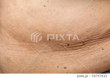 Senior women body fat belly front view, Black moles, Unhealthy  concept 59747632