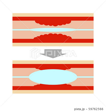 血管のステント治療 血管のステント治療 59762566
