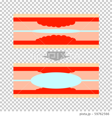 血管のステント治療 血管のステント治療 59762566