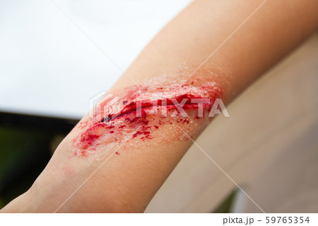 The fake wound on the arm for boy Asia 59765354