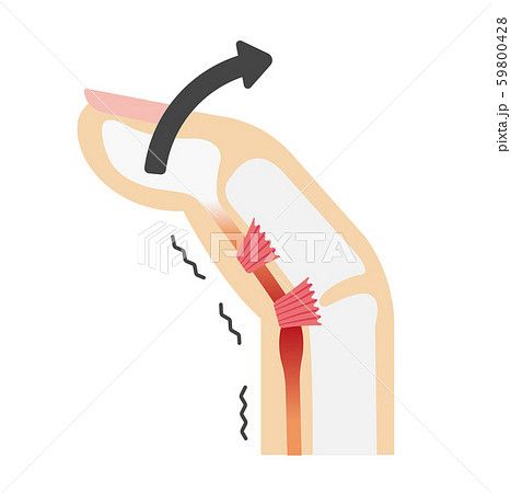 ばね指 バネ指 弾撥指 原因と症状 骨格解剖図イラスト 伸ばすときのイラスト素材