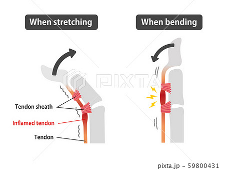 ばね指 バネ指 弾撥指 原因と症状 骨格解剖図イラスト 英語 解説文なし のイラスト素材