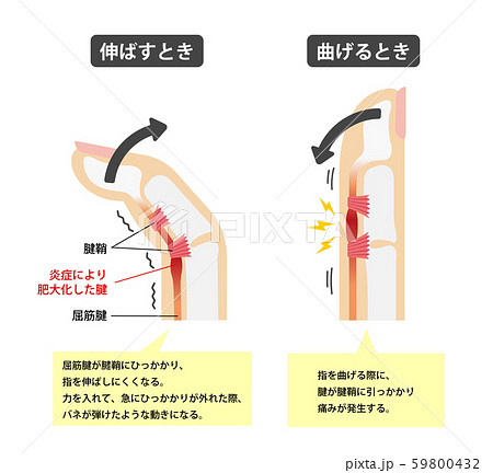 ばね指・バネ指 (弾撥指) / 原因と症状　骨格解剖図イラスト / 日本語 (解説文つき) 59800432