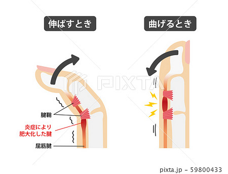 ばね指・バネ指 (弾撥指) / 原因と症状 骨格解剖図イラスト / 日本語 (解説文なし) ばね指・バネ指 (弾撥指) / 原因と症状 骨格解剖図イラスト / 日本語 (解説文なし) 59800433