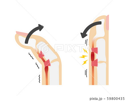 ばね指 バネ指 弾撥指 原因と症状 骨格解剖図イラスト 文字なしのイラスト素材