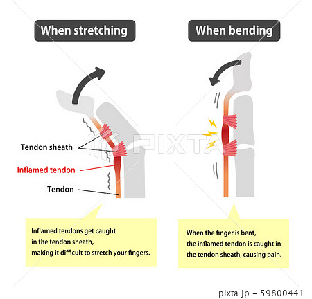 ばね指 バネ指 弾撥指 原因と症状 骨格解剖図イラスト 英語 解説文つき のイラスト素材