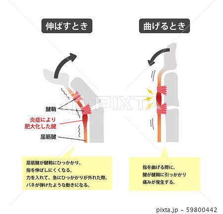 ばね指 バネ指 弾撥指 原因と症状 骨格解剖図イラスト 日本語 解説文つき のイラスト素材