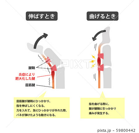 ばね 指 と は ばね指